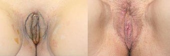 Labiaplasty before and after photos before 163822