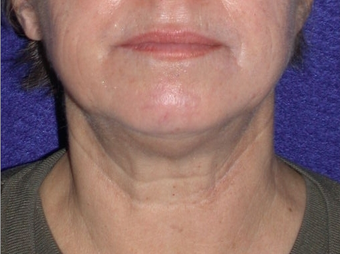 Necklift before 208443