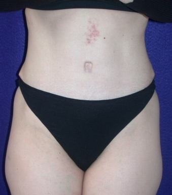 Tummy Tuck (abdominoplasty) after 208463