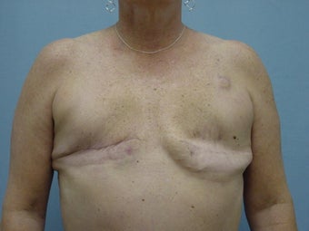 Breast Reconstruction before 98013