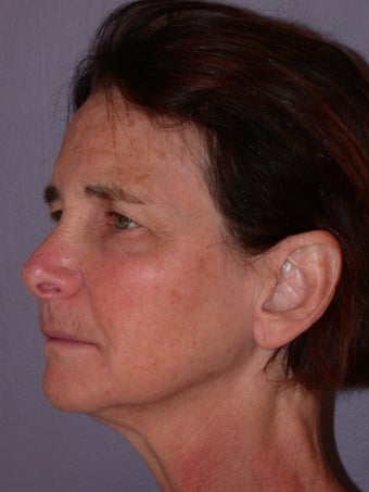 Neck lift before 306411