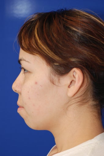 Chin Implant before 365471