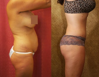 tummy tuck after 637904