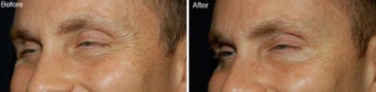 Botox for Crows Feet before 97870