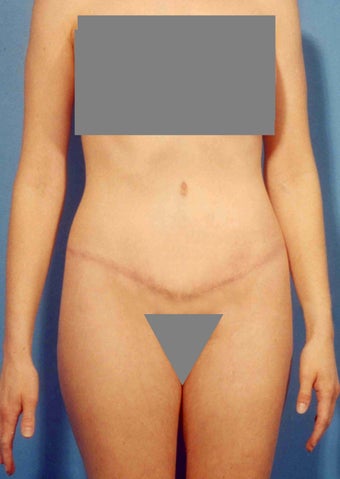 Abdominoplasty after 356352