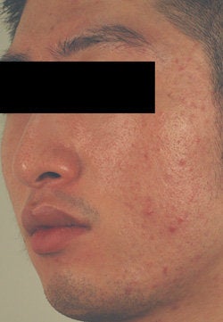 Laser Resurfacing before 89101