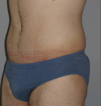 Male Abdominoplasty 586638