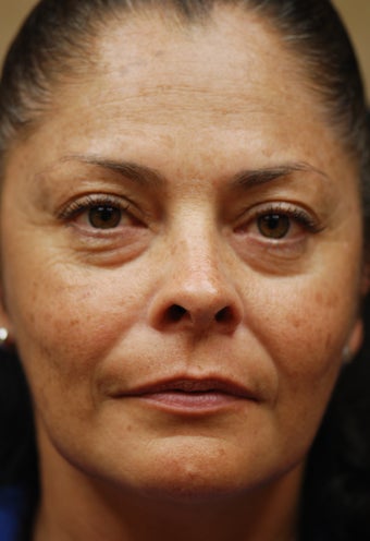 Sculptra Aesthetic after 581305