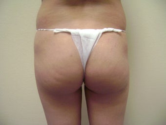 Brazilian Butt Lift before 138166