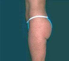 Smartlipo 401662