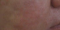 Severe Acne Rosacea Treatment before 272037