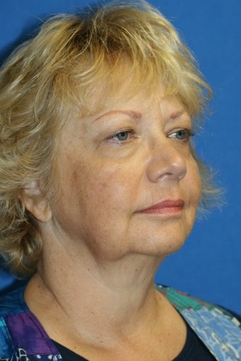 Face Lift 367591