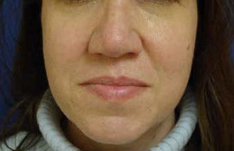 Rhinoplasty after 321766