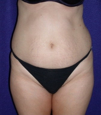 Tummy Tuck (abdominoplasty) before 208478