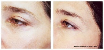Laser skin resurfacing for crow's feet before 6606