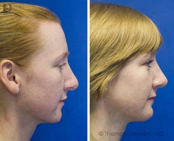 Revision Rhinoplasty, Chin Implantation, Mole Excision after 234398