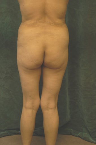 Women's Buttocks Augmentation 518115
