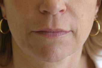 Lip Augmentation with Silicone before 101600