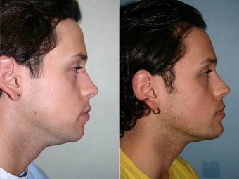 chin augmentation before 311837