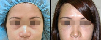 Lower Eyelid(Blepharoplasty) Surgery before 652502