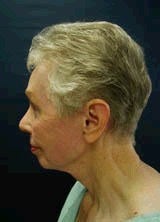 Chin Implants after 357644