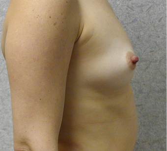 Mommy Makeover 408158
