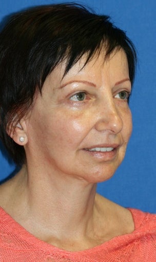Facelift, Fat Transfer, Upper Bleph, Lower Eyelid Skin Pinch after 519865