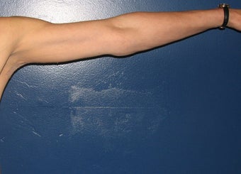 Brachioplasty after 576423