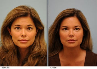Botox before 362602