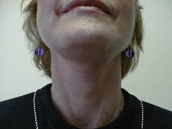 Neck lift after 593722