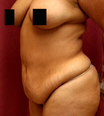 tummy tuck 304677