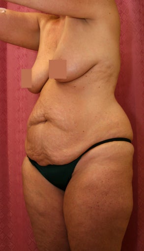 tummy tuck 304685