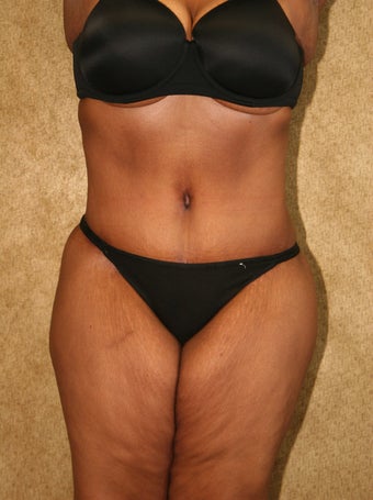tummy tuck 304688