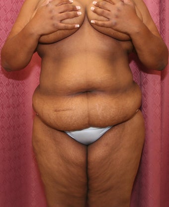 tummy tuck 304688