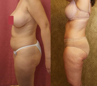 tummy tuck 304702