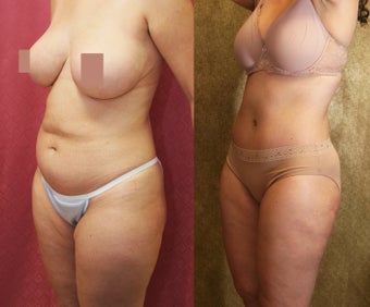 tummy tuck 304702