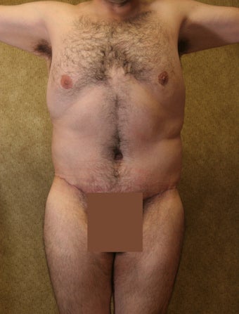 body lift 304707
