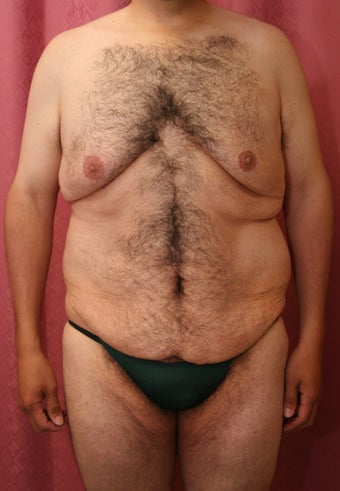 body lift 304707