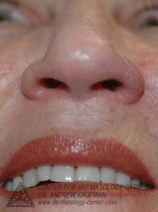 Mohs Surgery of Basal Cell Carcinoma and Recontruction 315015