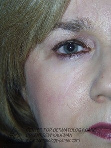 Mohs Surgery of Lentigo Maligna (Melanoma) and Reconstruction 315082