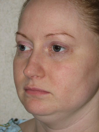 Smartlipo of the Neck and Jowls 316496