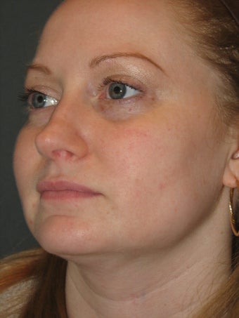 Smartlipo of the Neck and Jowls 316496