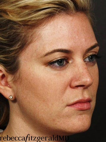 Sculptra / IPL 318457