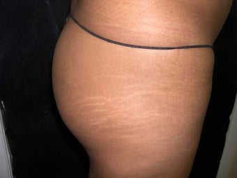 Butt Lift 330213