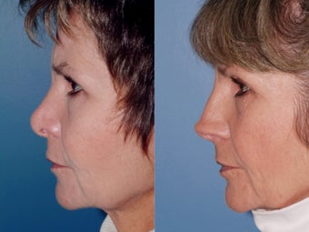 Revision rhinoplasty 334293