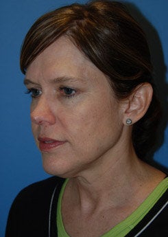 Face Lift, Neck Lift, Brow Lift 338013