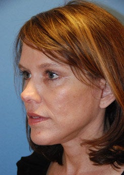 Face Lift, Neck Lift, Brow Lift 338013
