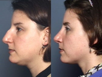 Nose Surgery 338487