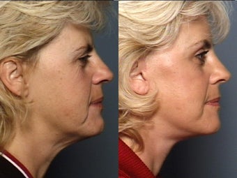 Brow Lift 338618