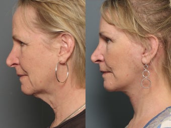 Brow Lift 338627